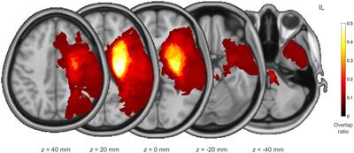 Stratified predictions of upper limb motor outcomes after stroke